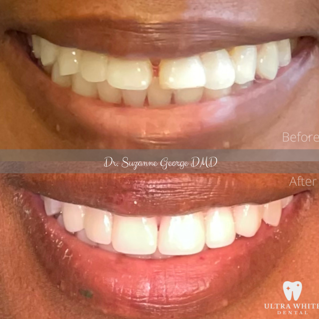 Free Virtual Veneer Consultation Ultra White Dental Clinic